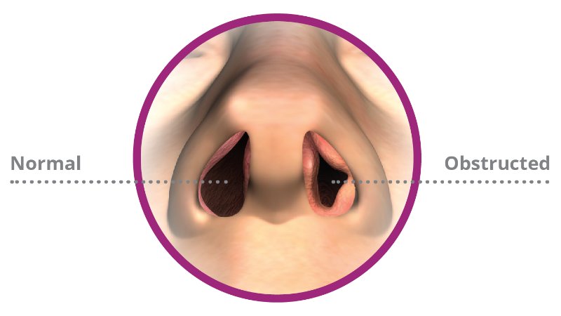 obstructed and normal nasal passage